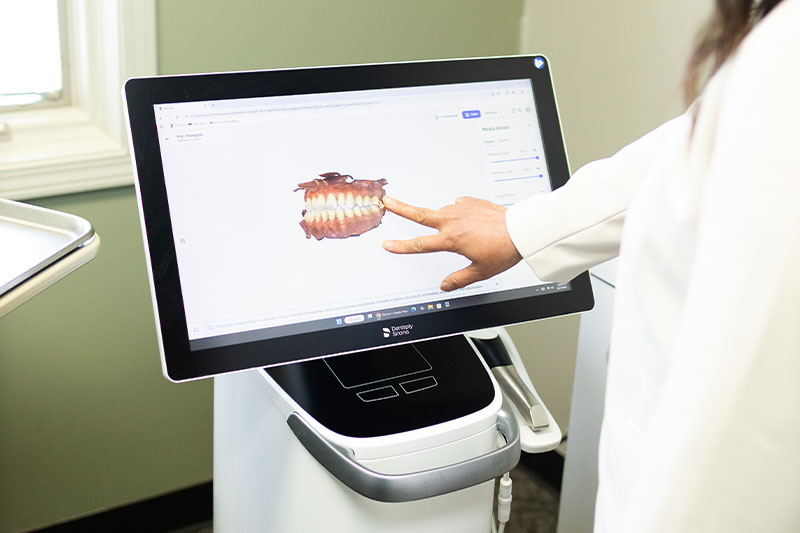 Itero Intra-Oral Scanner  in Indianapolis