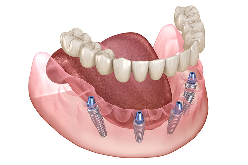 All on 4 Dental Implants in Indianapolis