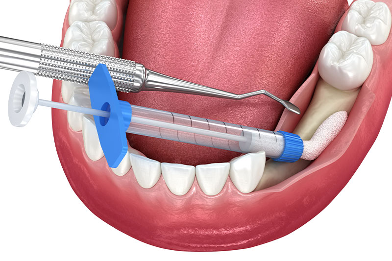 Bone Grafting in Indianapolis