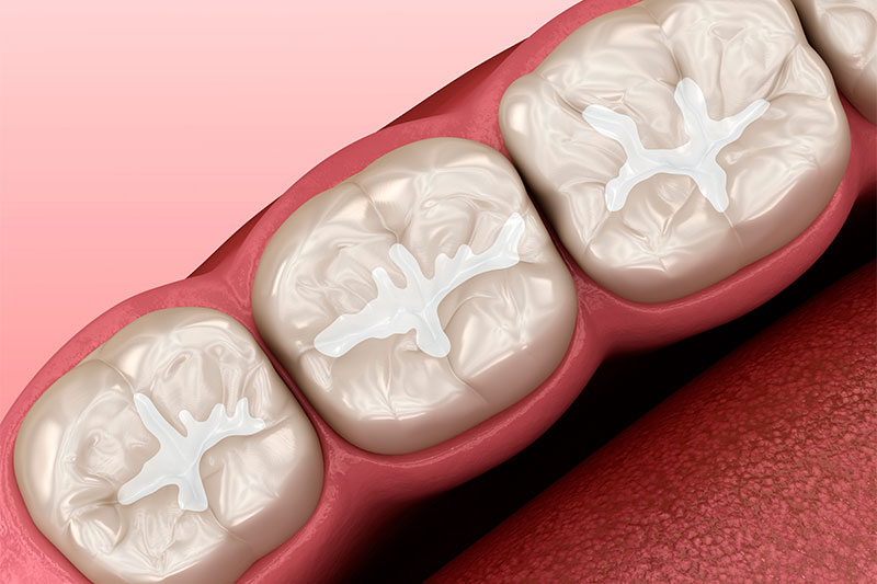 Dental Sealants in Indianapolis