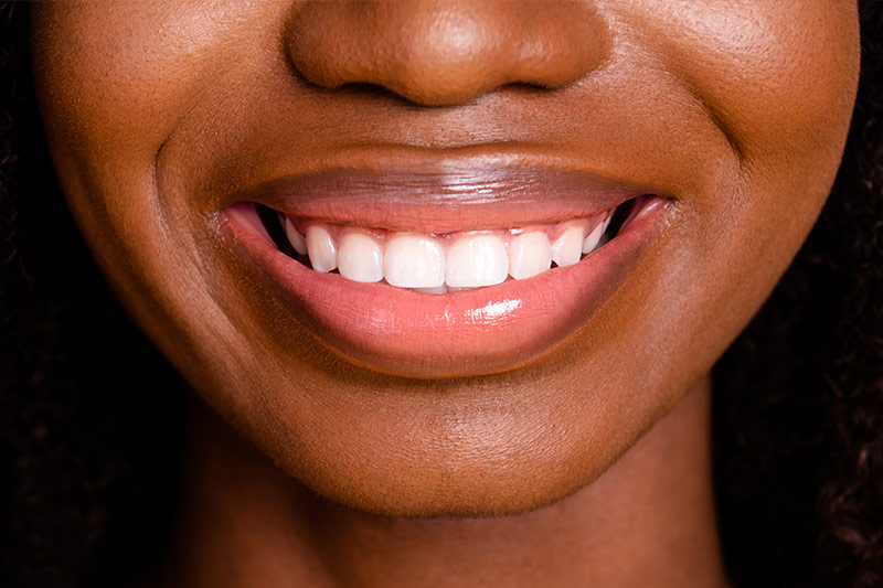 Gum Contouring in Indianapolis
