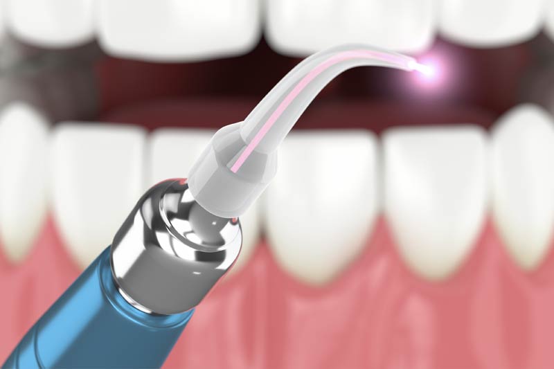 Laser Dentistry in Indianapolis