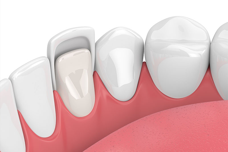Porcelain Veneers in Indianapolis